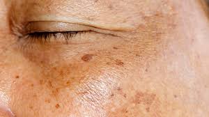 UZ P0M0Ć PERŠINA ZAUVlJEK UKL0NlTE STARAČKE MRLJE! Ovo Morate Napraviti…