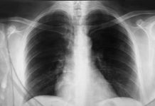 OD GNOJENJA DO OTKAZIVANJA ORGANA! Ovo su glavni simptomi UPALE PLUĆA! Odnela i slavnu OSKAROVKU