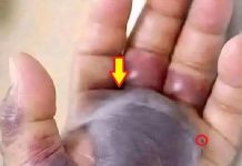 Kada mala povreda postane ozbiljan problem: Kako na vrijeme prepoznati opasne infekcije kože