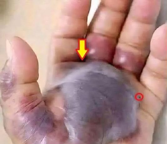 Kada mala povreda postane ozbiljan problem: Kako na vrijeme prepoznati opasne infekcije kože