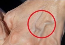 Zašto se Pojavljuju Plave Vene na Rukama? Šta Je Normalno, a Kada Treba Reagovati