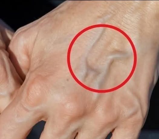 Zašto se Pojavljuju Plave Vene na Rukama? Šta Je Normalno, a Kada Treba Reagovati