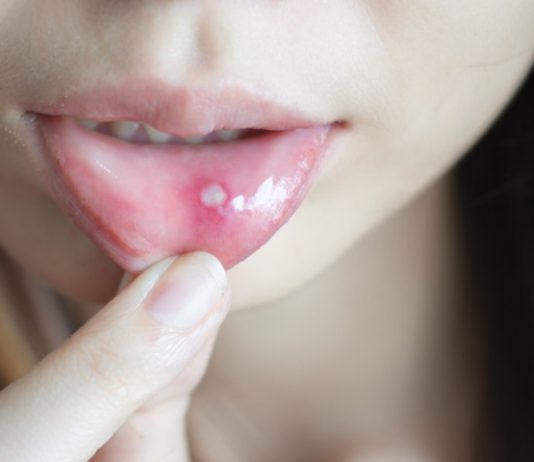 Muče vas afte u ustima? Evo zašto nastaju i kako se riješiti neugodne boli