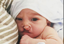 Priča majke koja je ponosno podijelila fotografije sina rođenog s rascjepom usne i nepca