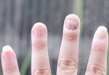 Sinoc sam namazala ovu smjesu na gljivice na noktima: one su nestale kao rukom odnesene, genijalan recept mi spasio zivot