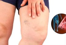 Simptomi krvnih ugrušaka u tijelu: Ako primijetite, odmah potražite medicinsku pomoć