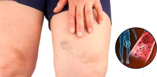 Simptomi krvnih ugrušaka u tijelu: Ako primijetite, odmah potražite medicinsku pomoć