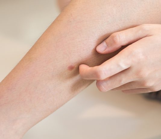 „Šta uzrokuje svrab na različitim dijelovima tijela: kada je bezopasan, a kada potražiti savjet ljekara“