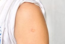 Mali ožiljak na ruci koji ima gotovo cijeli svijet: istina o BCG vakcinama i čestim zabludama