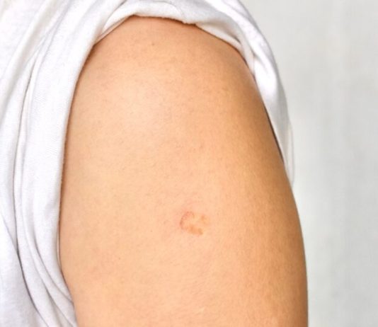 Mali ožiljak na ruci koji ima gotovo cijeli svijet: istina o BCG vakcinama i čestim zabludama