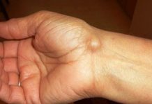 Imate li ovakve IZRASLINE: Evo kako da ih se riješite PREKO NOĆI