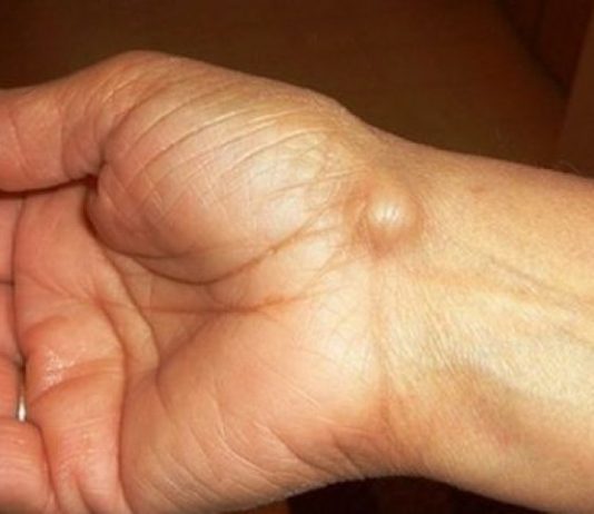 Imate li ovakve IZRASLINE: Evo kako da ih se riješite PREKO NOĆI