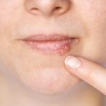 Kada herpes prestaje biti zarazan? Evo što treba znati