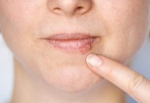 Kada herpes prestaje biti zarazan? Evo što treba znati