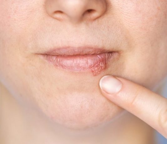 Kada herpes prestaje biti zarazan? Evo što treba znati