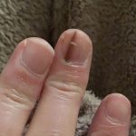 Elizabeta je primetila na noktu belu i crnu mrlju, otišla kod doktora i rekli joj da se udarila: Kad joj nije prošlo, vratila se i nastao je haos