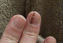 Elizabeta je primetila na noktu belu i crnu mrlju, otišla kod doktora i rekli joj da se udarila: Kad joj nije prošlo, vratila se i nastao je haos