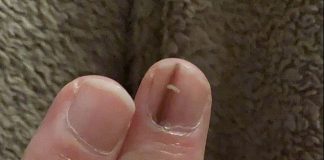 Elizabeta je primetila na noktu belu i crnu mrlju, otišla kod doktora i rekli joj da se udarila: Kad joj nije prošlo, vratila se i nastao je haos