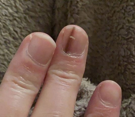 Elizabeta je primetila na noktu belu i crnu mrlju, otišla kod doktora i rekli joj da se udarila: Kad joj nije prošlo, vratila se i nastao je haos