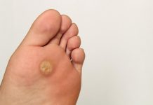 Kada dobijete „plantarni žulj“, to nije obično kukuruzno oko ono pušta korjen. Kako prepoznati razliku između žuljeva i kurjih očiju na stopalima