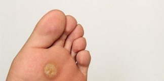 Kada dobijete „plantarni žulj“, to nije obično kukuruzno oko ono pušta korjen. Kako prepoznati razliku između žuljeva i kurjih očiju na stopalima