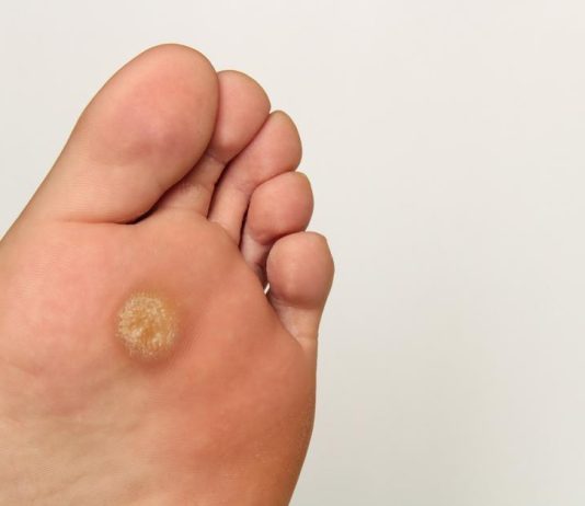 Kada dobijete „plantarni žulj“, to nije obično kukuruzno oko ono pušta korjen. Kako prepoznati razliku između žuljeva i kurjih očiju na stopalima