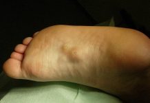 KVRŽICE NA NOZI MOGU DA UKAŽU NA PO ŽIVOT OPASNO STANJE: Ne ignorišite ove simptome