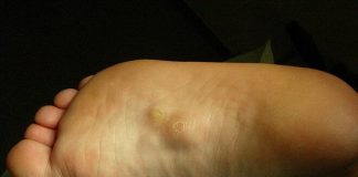 KVRŽICE NA NOZI MOGU DA UKAŽU NA PO ŽIVOT OPASNO STANJE: Ne ignorišite ove simptome