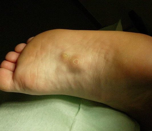 KVRŽICE NA NOZI MOGU DA UKAŽU NA PO ŽIVOT OPASNO STANJE: Ne ignorišite ove simptome