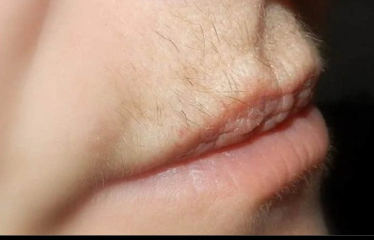 Dlačice iznad usana ovako će zauvijek nestati: Trik u koji se kunu milioni žena