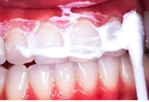 Držite ovu smjesu u ustima 60 sekundi i uklonit ćete većinu kamenca sa zuba!