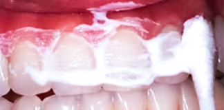 Držite ovu smjesu u ustima 60 sekundi i uklonit ćete većinu kamenca sa zuba!