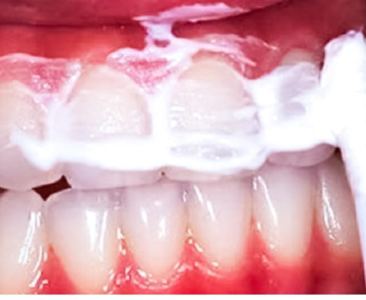 Držite ovu smjesu u ustima 60 sekundi i uklonit ćete većinu kamenca sa zuba!