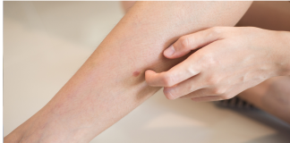 Šta uzrokuje svrab na različitim dijelovima tijela: kada je bezopasan, a kada potražiti savjet ljekara