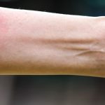 Ubod stršljena ga odveo na rub smrti,Ispovijest muškarca kojeg je napao roj stršljena ledi krv u žilama: „Srce mi je prestalo kucati, ali čudo me vratilo!