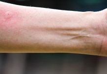 Ubod stršljena ga odveo na rub smrti,Ispovijest muškarca kojeg je napao roj stršljena ledi krv u žilama: „Srce mi je prestalo kucati, ali čudo me vratilo!