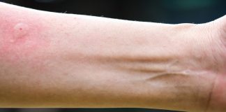 Ubod stršljena ga odveo na rub smrti,Ispovijest muškarca kojeg je napao roj stršljena ledi krv u žilama: „Srce mi je prestalo kucati, ali čudo me vratilo!