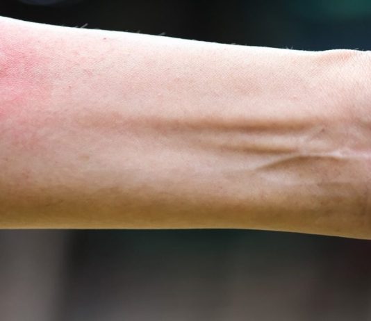 Ubod stršljena ga odveo na rub smrti,Ispovijest muškarca kojeg je napao roj stršljena ledi krv u žilama: „Srce mi je prestalo kucati, ali čudo me vratilo!